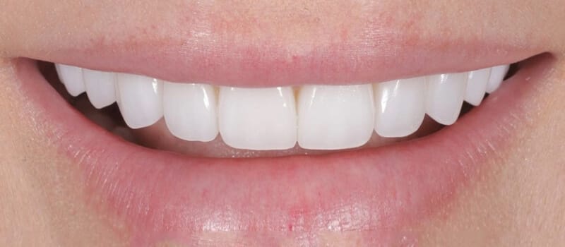 After - Veneers at Elite Dental Implants and Orthodontics