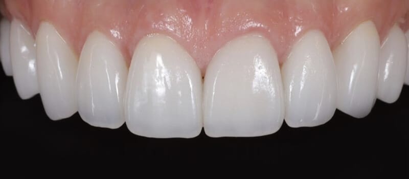 After - Veneers at Elite Dental Implants and Orthodontics