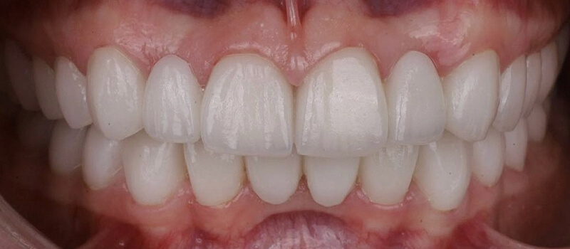 After - Veneers at Elite Dental Implants and Orthodontics