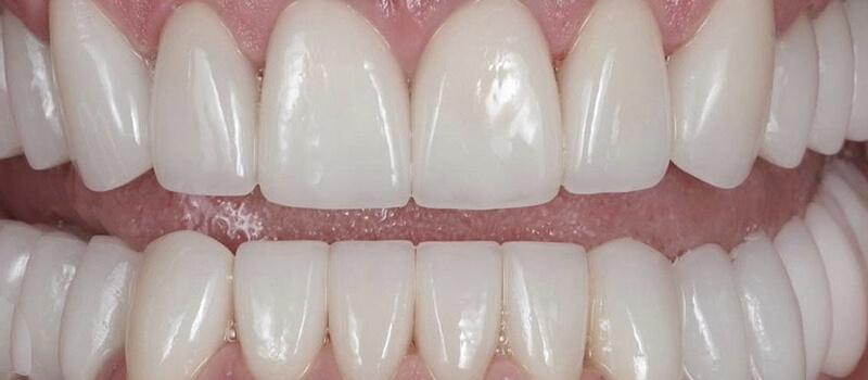 After - Veneers at Elite Dental Implants and Orthodontics