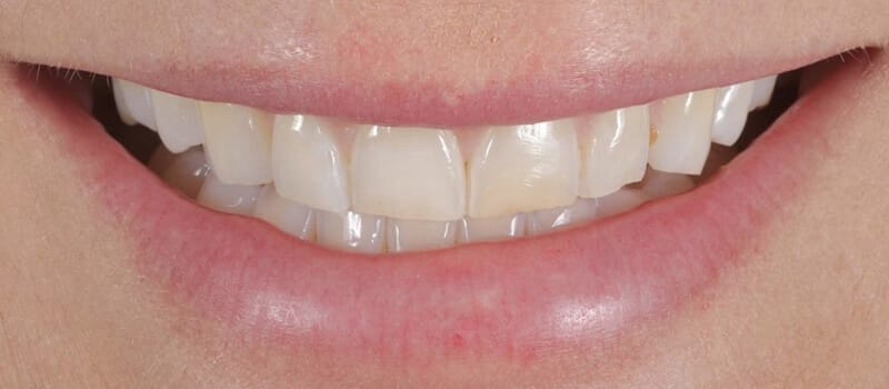 Before - Veneers at Elite Dental Implants and Orthodontics