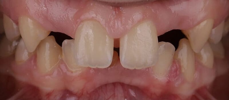 Before - Veneers at Elite Dental Implants and Orthodontics