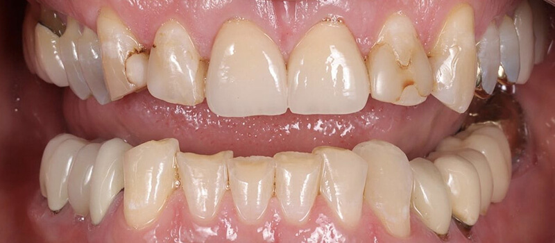 Before - Veneers at Elite Dental Implants and Orthodontics