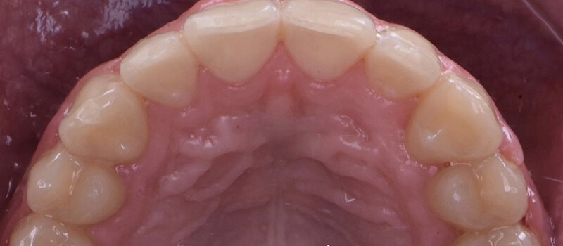 After - Braces at Elite Dental Implants and Orthodontics