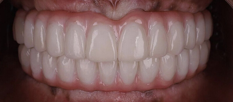 After - All-on-4 at Elite Dental Implants and Orthodontics