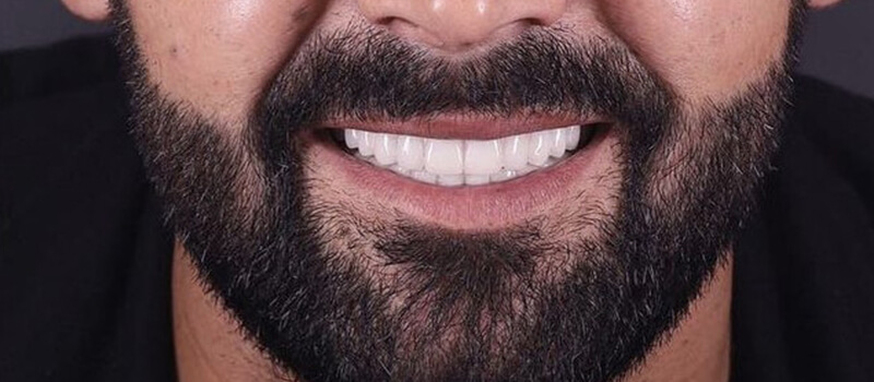 After - All-on-4 at Elite Dental Implants and Orthodontics