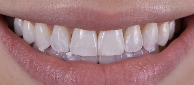 After - Invisalign at Elite Dental Implants and Orthodontics