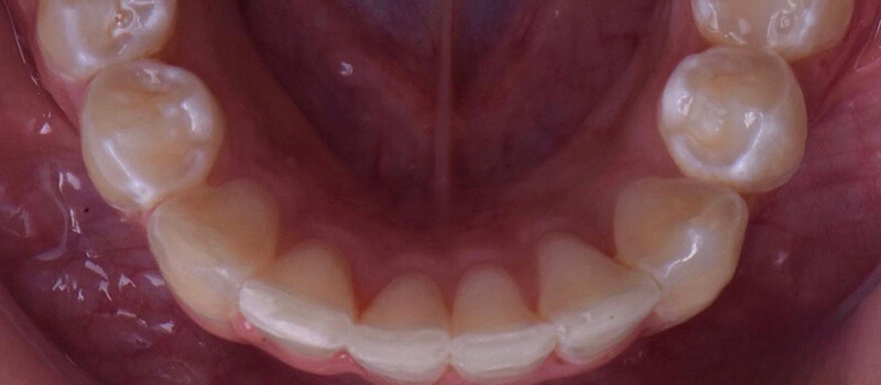 After - Invisalign at Elite Dental Implants and Orthodontics