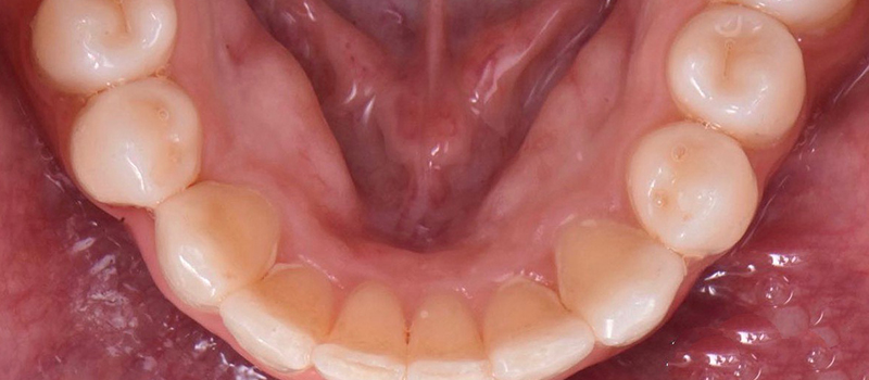 After - Invisalign at Elite Dental Implants and Orthodontics