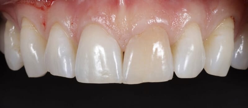 Before - Veneers at Elite Dental Implants and Orthodontics