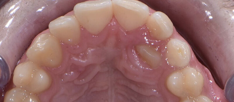 Before - Braces at Elite Dental Implants and Orthodontics