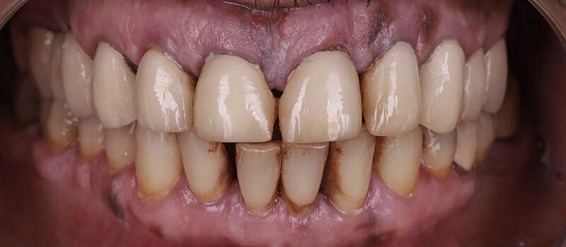 Before - All-on-4 at Elite Dental Implants and Orthodontics