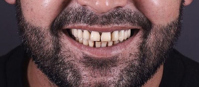 Before - All-on-4 at Elite Dental Implants and Orthodontics