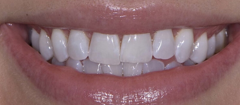 Before - Invisalign at Elite Dental Implants and Orthodontics