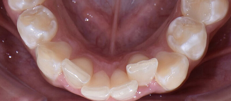 Before - Invisalign at Elite Dental Implants and Orthodontics