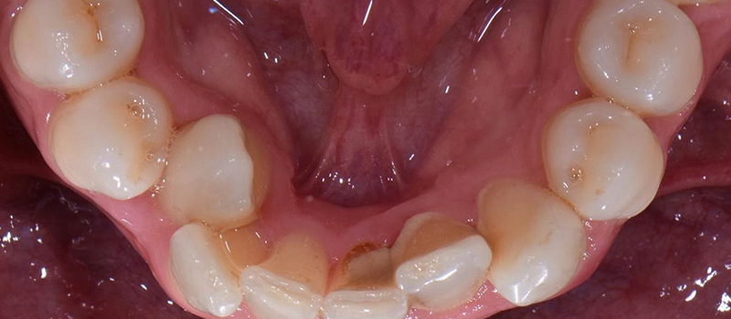 Before - Invisalign at Elite Dental Implants and Orthodontics