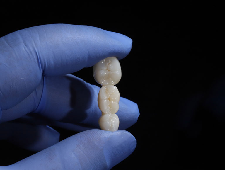 Restore Your Smile with a Dental Bridge