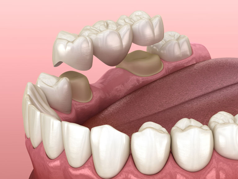 Dental Bridge