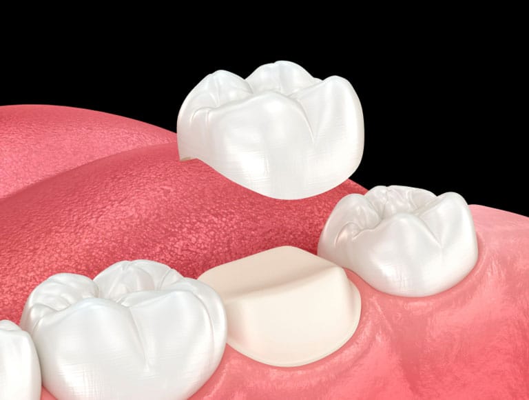 Dental Crown