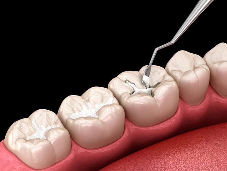 Dental Sealants