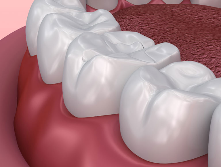 Dental Sealants