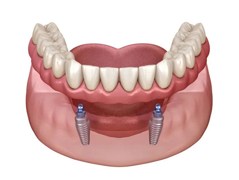 Fixed vs. Removable Implant Solutions