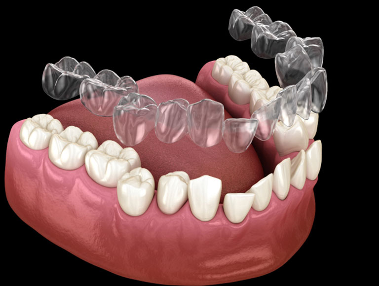 Invisalign