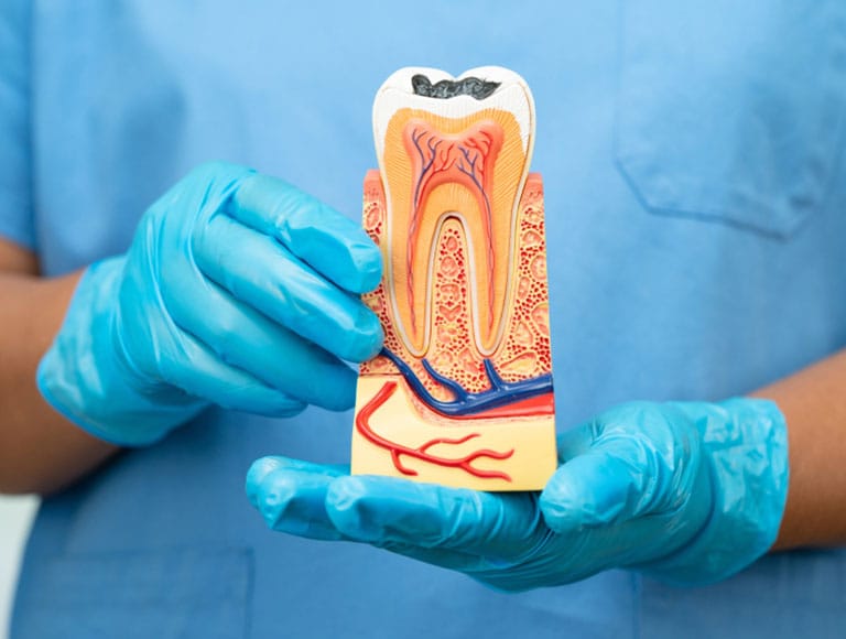 Is a Root Canal Right for You?