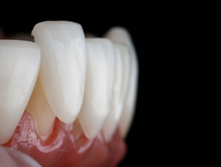 Dental Crowns