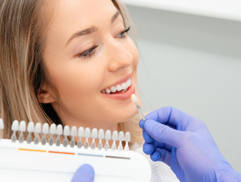 Dental Veneers