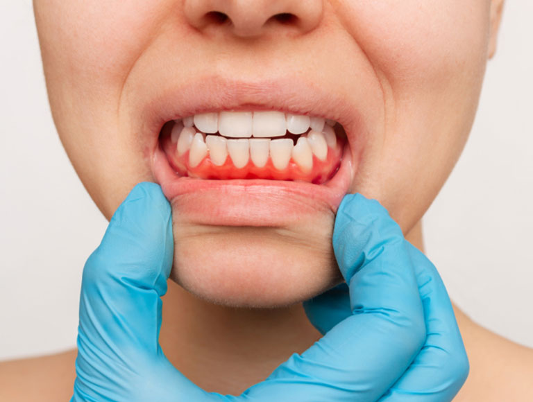 Gum Disease Treatment