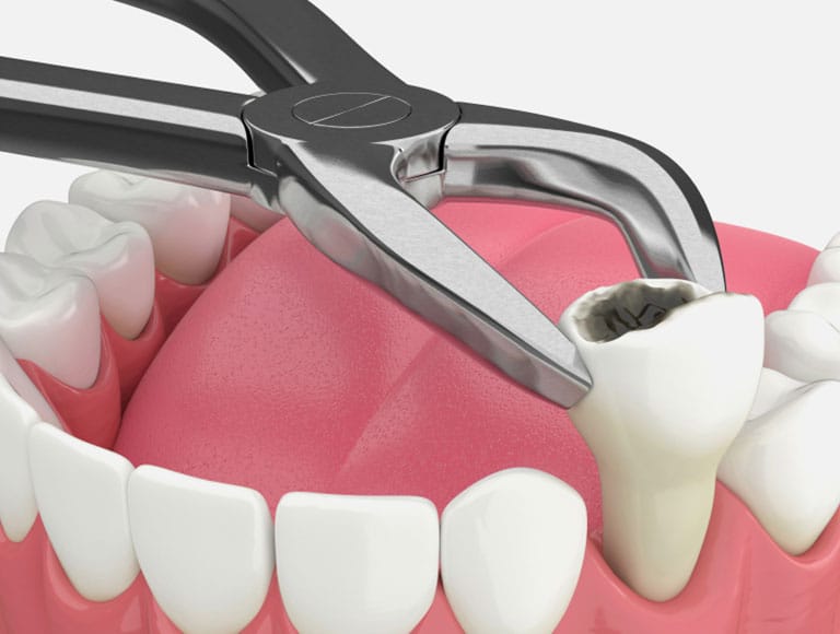 Tooth Extraction