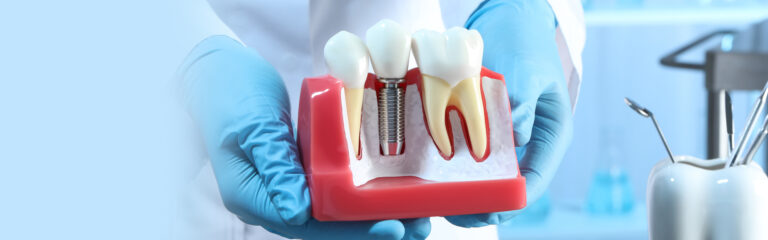 Look And Feel like Your Own Teeth with All on 4 Dental Implants